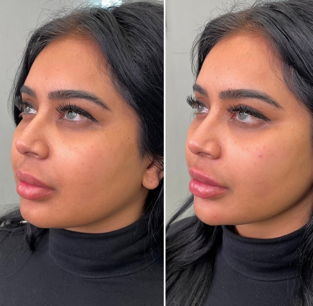 Cheek Fillers Before After Round See My Flawless New Face - r02jg6y